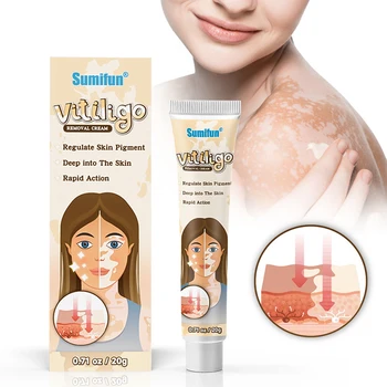 Vitiligom Zdravljenje Smetano Pigmentacija Kože, Zdravljenje Vitiligom Nega Krema ali Kožo Vitiligom Leukoplakia Izboljšanje Pigmentacijo Kože